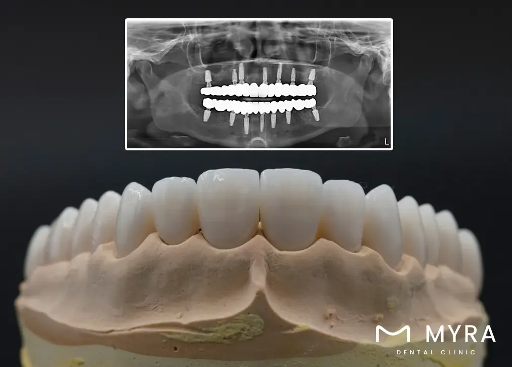 What are All-on-6 Dental Implants_ model zirkonlu resm röntgenle.webp